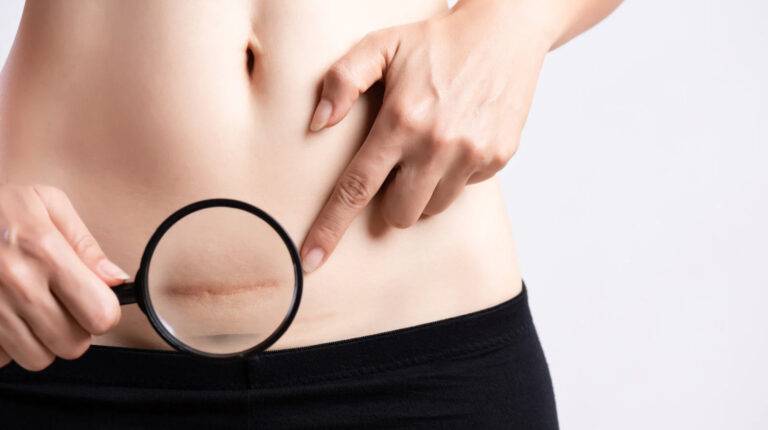 Laser para cicatrizes pós-cirúrgicas: quando vale a pena fazer?